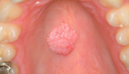 Papilloma guancia interna
