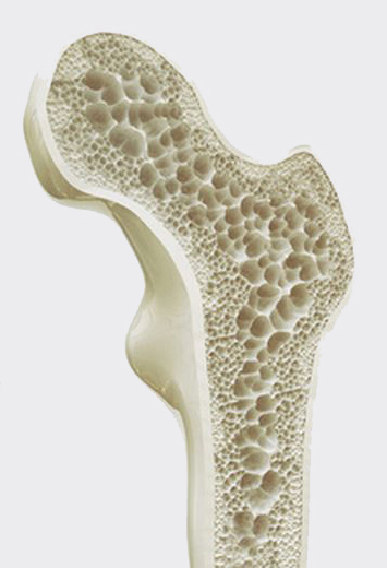 osso osteoporotico